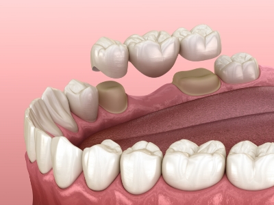 Illustrated dental bridge being placed to replace a missing tooth