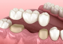 Illustrated traditional dental bridge being fitted over two natural teeth