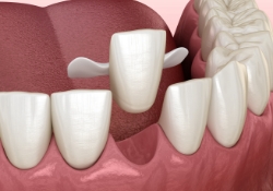 Illustrated dental bridge with artificial tooth and porcelain hooks on each side