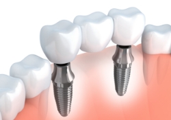 Two dental implants supporting a dental bridge