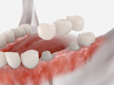 Model of dental bridge being placed