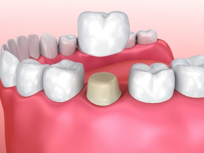 Illustration of a dental crown covering a tooth
