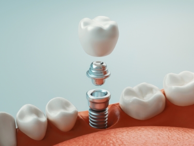 Illustrated abutment and dental crown being placed onto a dental implant