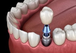 Illustrated dental crown being placed onto a dental implant