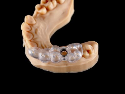 Surgical guide placed over a model of a row of teeth