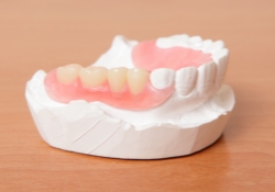 Model of the mouth with a partial denture replacing some teeth