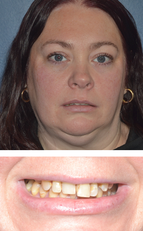 Close up of mouth with severely decayed and damaged teeth