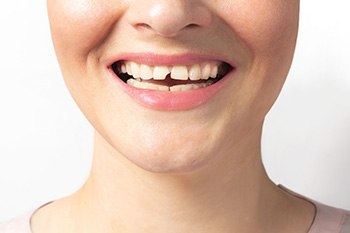 We can help you restore a cavity or broken tooth near Hackettstown, NJ