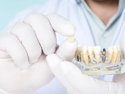 Dentist holding a dental implant crown and model