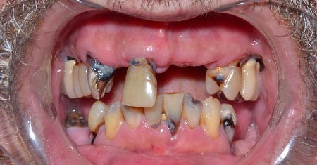 Mouth with several damaged and missing teeth