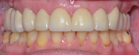 Mouth with flawless teeth after dental implant treatment