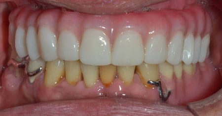 Mouth with a full set of well aligned teeth