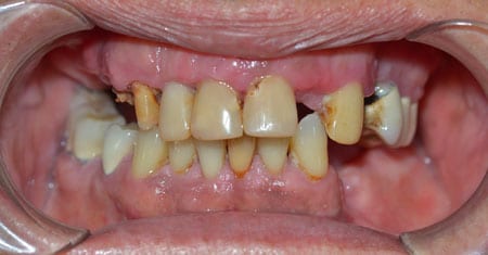 Mouth with misaligned teeth and several missing teeth