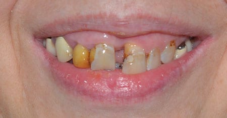Smile with several discolored and damaged teeth