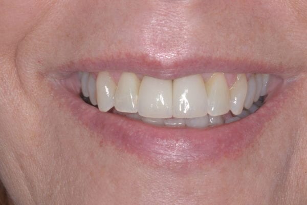 Smile after getting dental implants and teeth whitening