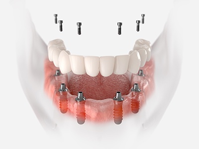 Illustration of fixed implant denture for lower arch