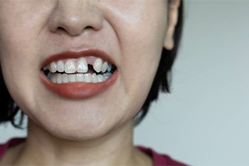 Woman missing a tooth