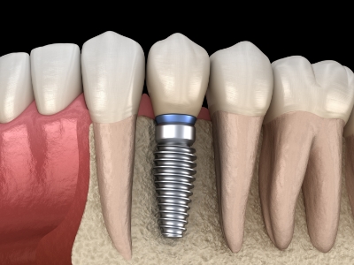 Illustrated dental implant with crown in the lower jaw