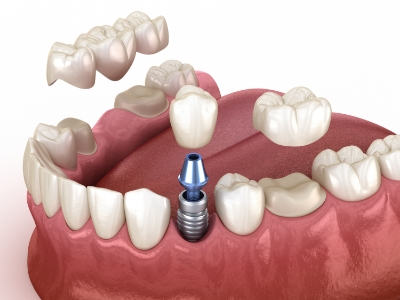 Illustrated dental implant dental bridge and a dental crown being placed in a row of teeth