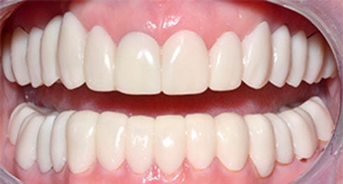 Close up of smile with straighter and whiter teeth
