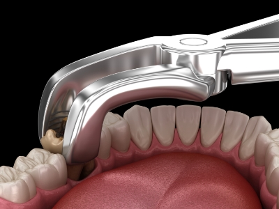 Illustrated dental clasp extracting a damaged tooth
