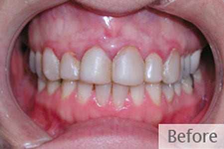 Mouth with discolored teeth