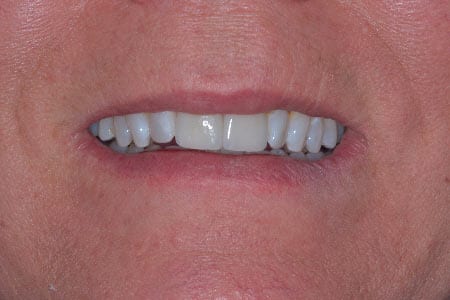 Close up of person smiling after teeth whitening treatment