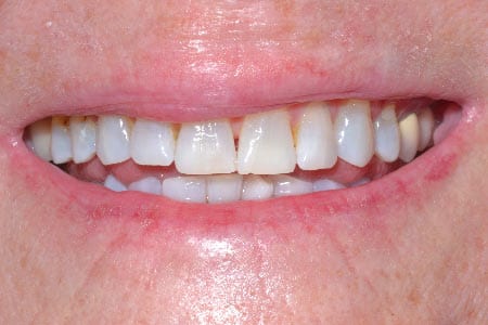 Close up of smile with whiter teeth