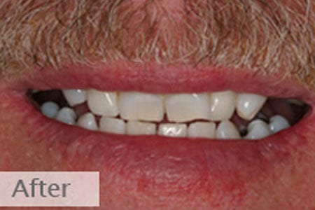 Mouth with brighter teeth after whitening treatment