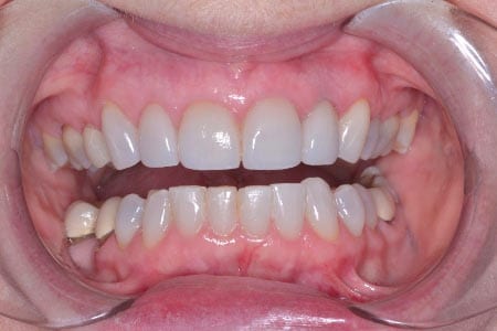 Close up of mouth with brighter teeth after whitening