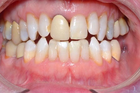 Close up of mouth with much whiter teeth
