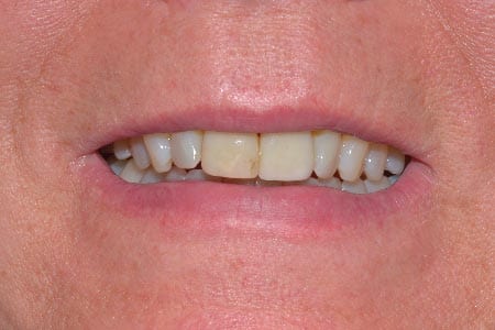 Close up of person smiling with slightly discolored teeth