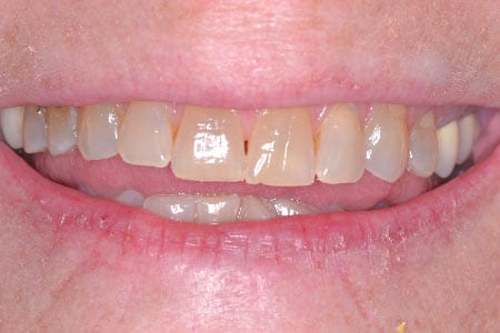 Close up of smile with slightly yellowed teeth