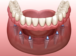 3D diagram of full arch dental implants