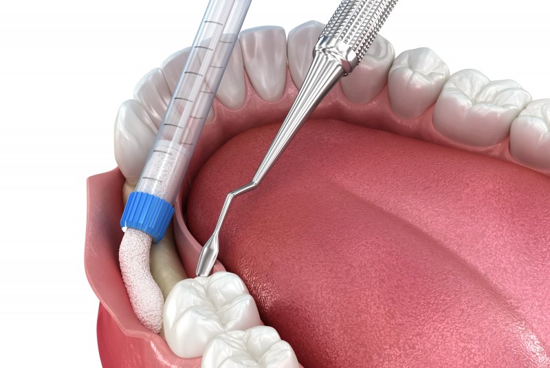 Digital image of bone grafting procedure